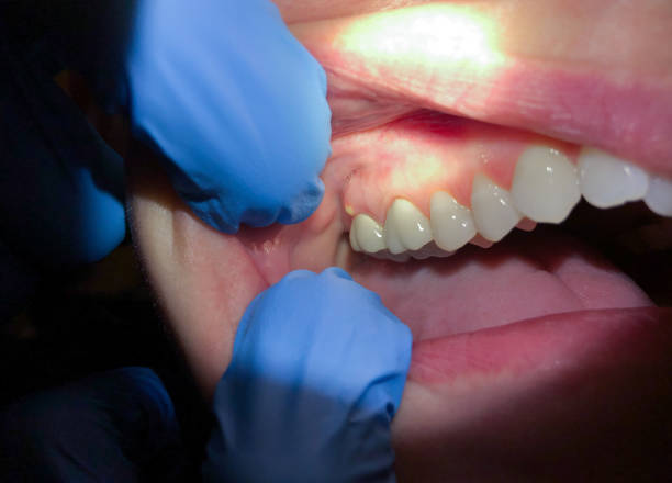 Emergency Gum Pain Relief in NM